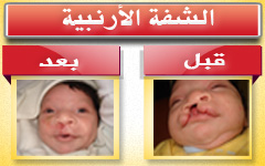 جراحات الشفة الأرنبية